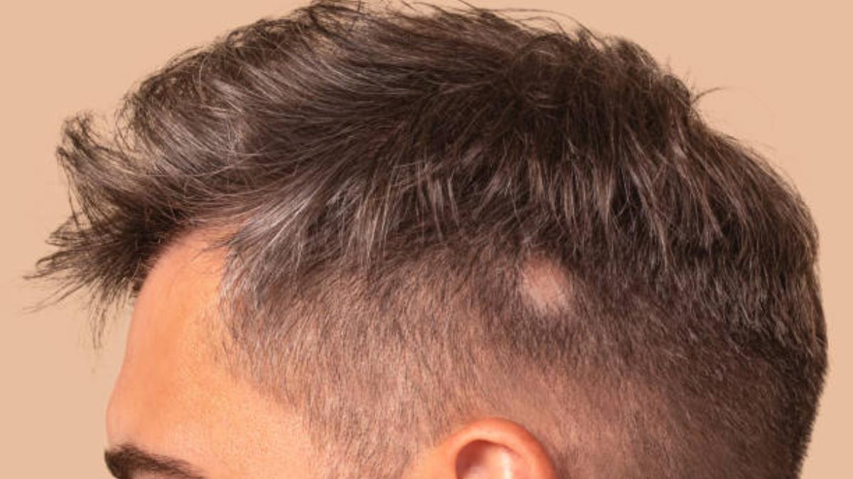 El secreto de especialistas para ponerle freno a la caída del cabello